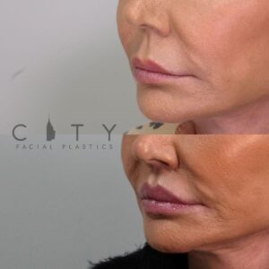 Elelyft ® Lip Lift Case 1 | Elelyft ® Upper Lip Lift, Dr. Gary Linkov Facial Plastic Surgeon