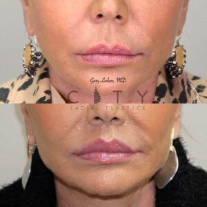 Elelyft ® Lip Lift Case 1 | Elelyft ® Upper Lip Lift, Dr. Gary Linkov Facial Plastic Surgeon