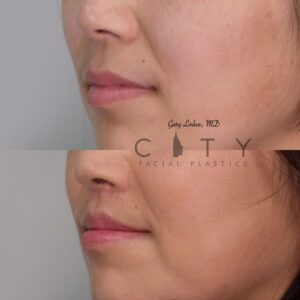 Elelyft ® Lip Lift Case 2 | Elelyft ® Upper Lip Lift, Dr. Gary Linkov Facial Plastic Surgeon