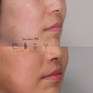 Elelyft ® Lip Lift Case 2 | Elelyft ® Upper Lip Lift, Dr. Gary Linkov Facial Plastic Surgeon