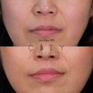 Elelyft ® Lip Lift Case 2 | Elelyft ® Upper Lip Lift, Dr. Gary Linkov Facial Plastic Surgeon