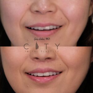 Elelyft ® Lip Lift Case 2 | Elelyft ® Upper Lip Lift, Dr. Gary Linkov Facial Plastic Surgeon
