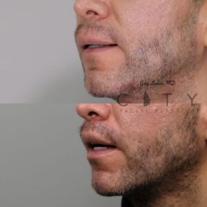 Elelyft ® Lip Lift Case 3 | Elelyft ® Upper Lip Lift, Dr. Gary Linkov Facial Plastic Surgeon