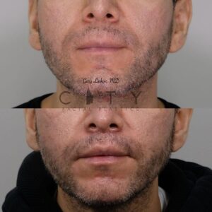 Elelyft ® Lip Lift Case 3 | Elelyft ® Upper Lip Lift, Dr. Gary Linkov Facial Plastic Surgeon