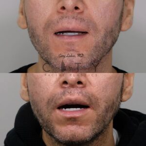Elelyft ® Lip Lift Case 3 | Elelyft ® Upper Lip Lift, Dr. Gary Linkov Facial Plastic Surgeon