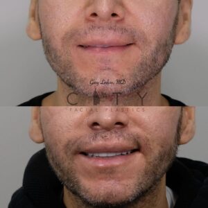 Elelyft ® Lip Lift Case 3 | Elelyft ® Upper Lip Lift, Dr. Gary Linkov Facial Plastic Surgeon