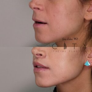 Elelyft ® Lip Lift Case 4 | Elelyft ® Upper Lip Lift, Dr. Gary Linkov Facial Plastic Surgeon