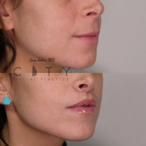 Elelyft ® Lip Lift Case 4 | Elelyft ® Upper Lip Lift, Dr. Gary Linkov Facial Plastic Surgeon