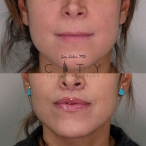 Elelyft ® Lip Lift Case 4 | Elelyft ® Upper Lip Lift, Dr. Gary Linkov Facial Plastic Surgeon