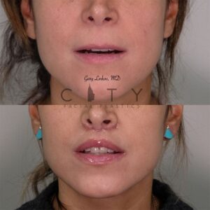 Elelyft ® Lip Lift Case 4 | Elelyft ® Upper Lip Lift, Dr. Gary Linkov Facial Plastic Surgeon