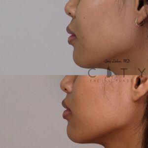 Elelyft ® Lip Lift Case 5 | Elelyft ® Upper Lip Lift, Dr. Gary Linkov Facial Plastic Surgeon