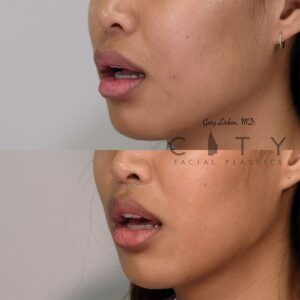 Elelyft ® Lip Lift Case 5 | Elelyft ® Upper Lip Lift, Dr. Gary Linkov Facial Plastic Surgeon