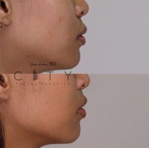 Elelyft ® Lip Lift Case 5 | Elelyft ® Upper Lip Lift, Dr. Gary Linkov Facial Plastic Surgeon