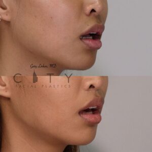 Elelyft ® Lip Lift Case 5 | Elelyft ® Upper Lip Lift, Dr. Gary Linkov Facial Plastic Surgeon