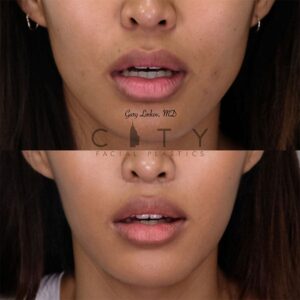 Elelyft ® Lip Lift Case 5 | Elelyft ® Upper Lip Lift, Dr. Gary Linkov Facial Plastic Surgeon