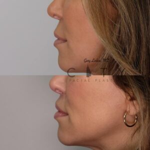 Elelyft ® Lip Lift Case 6 | Elelyft ® Upper Lip Lift, Dr. Gary Linkov Facial Plastic Surgeon