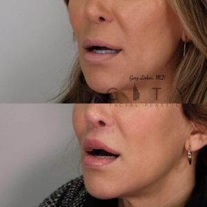 Elelyft ® Lip Lift Case 6 | Elelyft ® Upper Lip Lift, Dr. Gary Linkov Facial Plastic Surgeon
