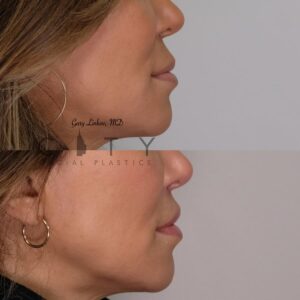 Elelyft ® Lip Lift Case 6 | Elelyft ® Upper Lip Lift, Dr. Gary Linkov Facial Plastic Surgeon