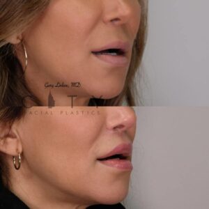 Elelyft ® Lip Lift Case 6 | Elelyft ® Upper Lip Lift, Dr. Gary Linkov Facial Plastic Surgeon