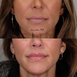 Elelyft ® Lip Lift Case 6 | Elelyft ® Upper Lip Lift, Dr. Gary Linkov Facial Plastic Surgeon