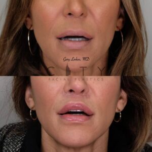Elelyft ® Lip Lift Case 6 | Elelyft ® Upper Lip Lift, Dr. Gary Linkov Facial Plastic Surgeon