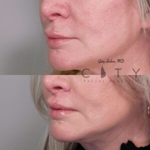Elelyft ® Lip Lift Case 7 | Elelyft ® Upper Lip Lift, Dr. Gary Linkov Facial Plastic Surgeon