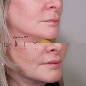 Elelyft ® Lip Lift Case 7 | Elelyft ® Upper Lip Lift, Dr. Gary Linkov Facial Plastic Surgeon