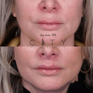 Elelyft ® Lip Lift Case 7 | Elelyft ® Upper Lip Lift, Dr. Gary Linkov Facial Plastic Surgeon