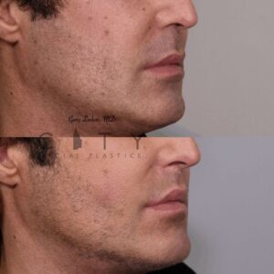 Elelyft ® Lip Lift Case 8 | Elelyft ® Upper Lip Lift, Dr. Gary Linkov Facial Plastic Surgeon