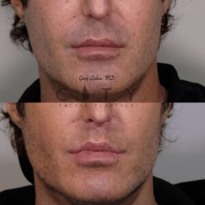 Elelyft ® Lip Lift Case 8 | Elelyft ® Upper Lip Lift, Dr. Gary Linkov Facial Plastic Surgeon