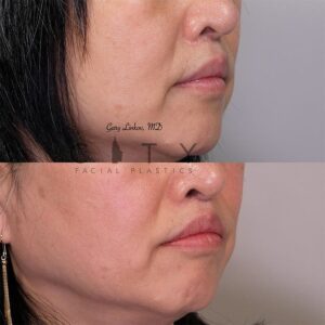Elelyft ® Lip Lift Case 9 | Elelyft ® Upper Lip Lift, Dr. Gary Linkov Facial Plastic Surgeon