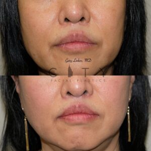 Elelyft ® Lip Lift Case 9 | Elelyft ® Upper Lip Lift, Dr. Gary Linkov Facial Plastic Surgeon