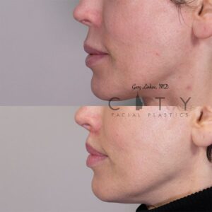 Elelyft ® Lip Lift Case 10 | Elelyft ® Upper Lip Lift, Dr. Gary Linkov Facial Plastic Surgeon