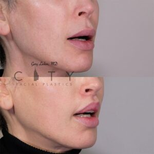 Elelyft ® Lip Lift Case 10 | Elelyft ® Upper Lip Lift, Dr. Gary Linkov Facial Plastic Surgeon