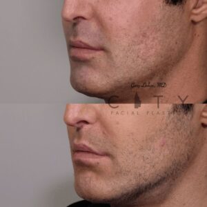 Elelyft ® Lip Lift Case 8 | Elelyft ® Upper Lip Lift, Dr. Gary Linkov Facial Plastic Surgeon
