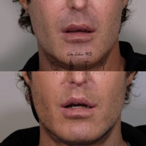 Elelyft ® Lip Lift Case 8 | Elelyft ® Upper Lip Lift, Dr. Gary Linkov Facial Plastic Surgeon