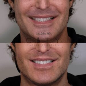 Elelyft ® Lip Lift Case 8 | Elelyft ® Upper Lip Lift, Dr. Gary Linkov Facial Plastic Surgeon