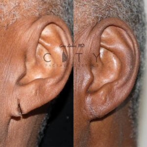 Facial reconstructive surgery case 1 | NYC Facial Reconstructive Plastic Surgery, New York Face Trauma