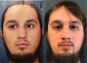 NYC Male Rhinoplasty