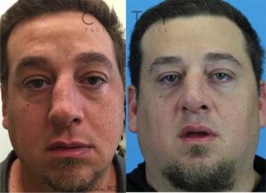 Male Rhinoplasty in New York City