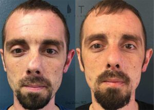 Best NYC Male Rhinoplasty