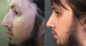 Male Rhinoplasty NYC