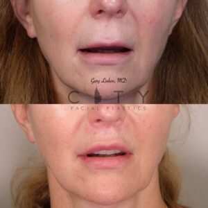 Elelyft ® Lip Lift Case 11 Frontal Mouth Open