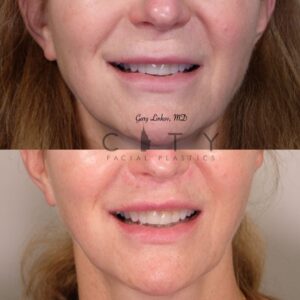 Elelyft ® Lip Lift Case 11 Frontal Mouth Open Smile