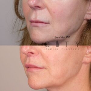 Elelyft ® Lip Lift Case 11 Left Oblique Mouth Closed