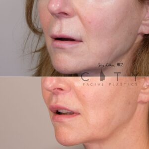 Elelyft ® Lip Lift Case 11 Left Oblique Mouth Open