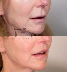Elelyft ® Lip Lift Case 11 Right Oblique