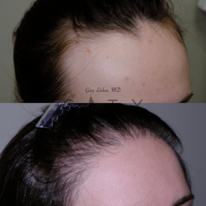 Hair-transplant_26_case_6_R-oblique