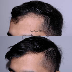 Hair Transplant in NYC - Oblique - Left