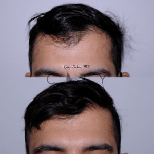Hair Transplant in NYC - Frontal